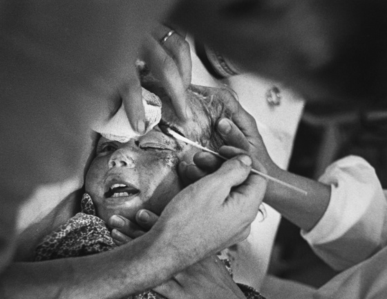 Country Doctor - Dr. Ernest Ceriani Swabbing Eye of Girl Kicked by Horse